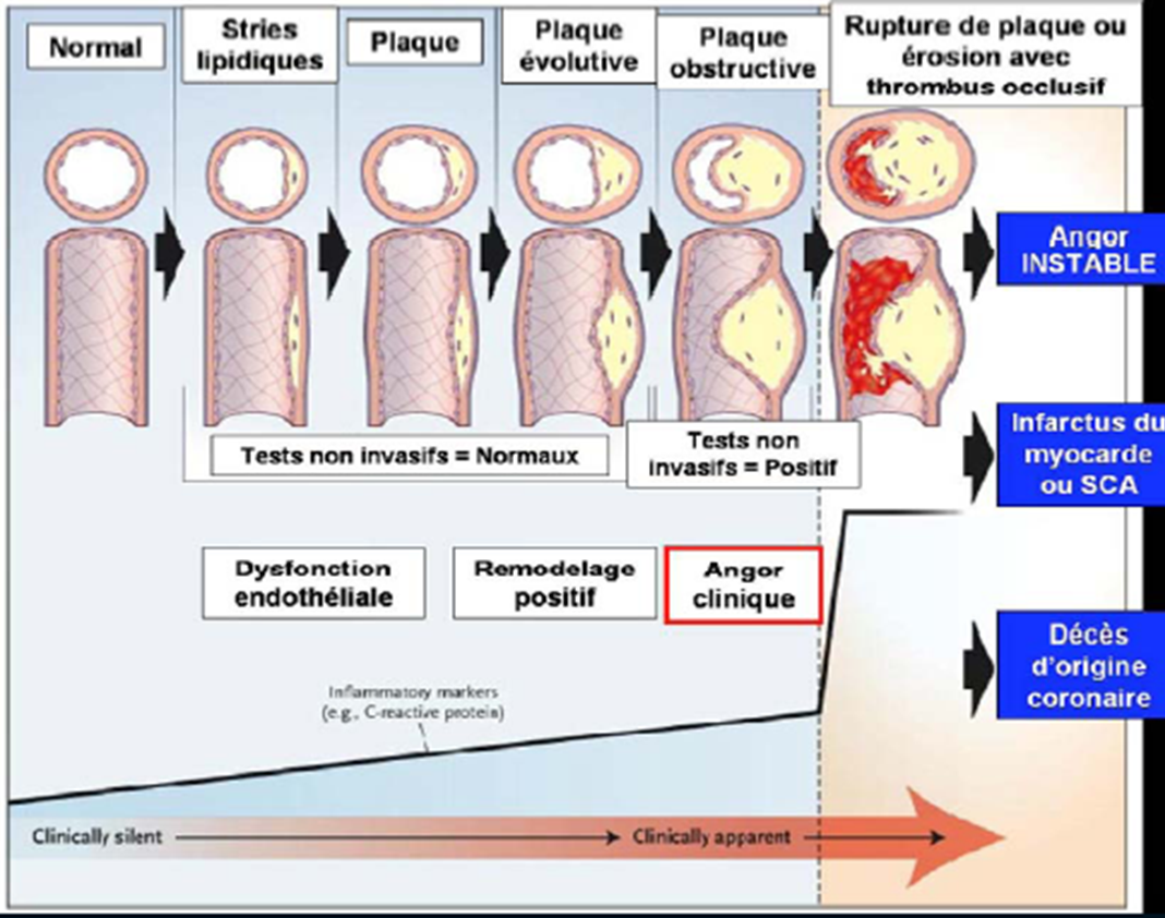 Physiopathologie de l’athérothrombose dans les syndromes coronaires aigus