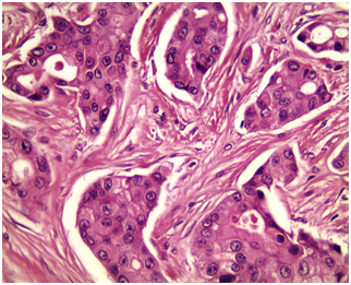 Breast cancer. Anatomopathological and molecular aspects