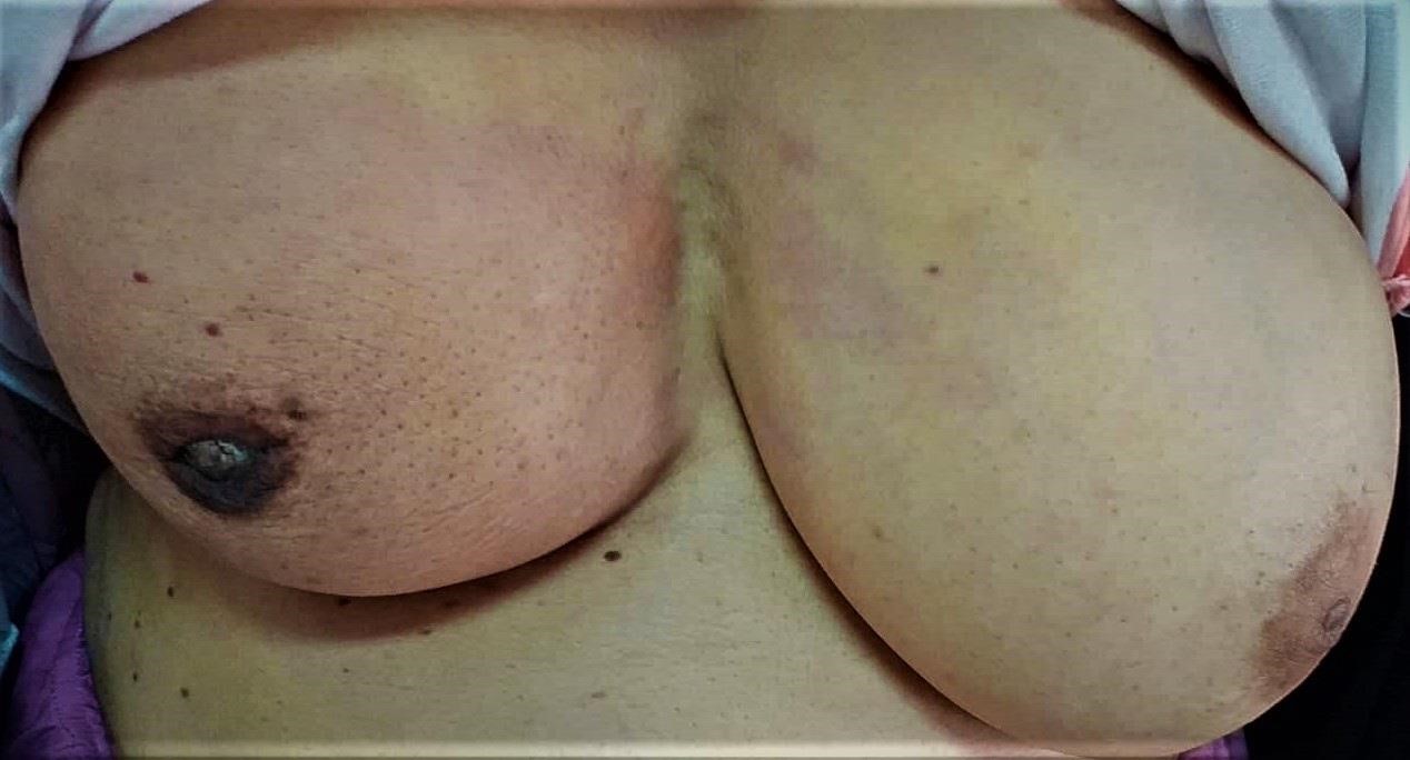 Inflammatory breast cancer: clinico-pathological particularities and principles of management.