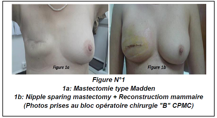 Surgical treatment of breast cancer.