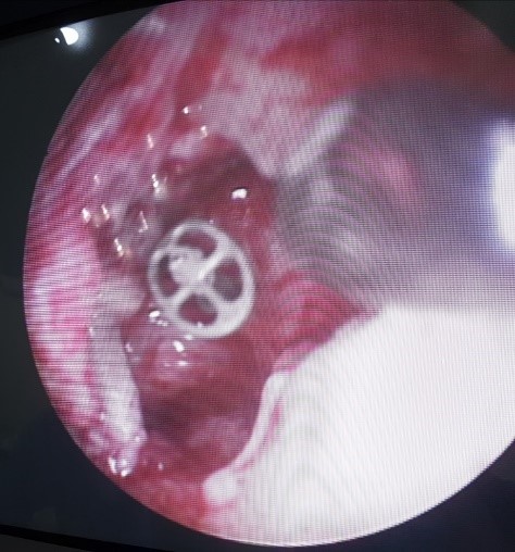 Cholestéatome de l’oreille moyenne : nos résultats fonctionnels
