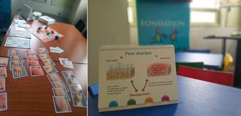 Dermatite atopique : Intérêt de l’éducation thérapeutique