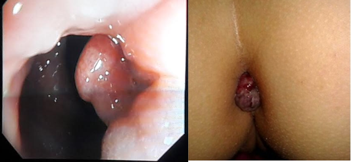 Les rectorragies de l’enfant, mise au point.