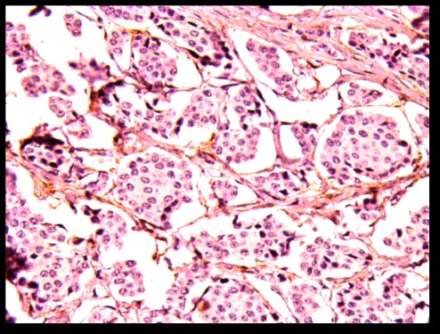 Classification commune des néoplasies neuroendocrines : commentaires.