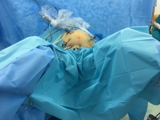 The laparoscopic approach in colon cancer