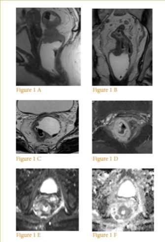 Rectal cancer: the essential points in MRI