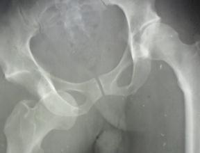 Résultats de réduction orthopédique des luxations coxofémorales chez l’adulte