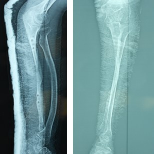 Reconstruction de l’ulna sur maladie exostosante par hémi-fibula non vascularisée