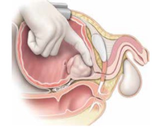 Les traitements chirurgicaux de l’hypertrophie bénigne de la prostate