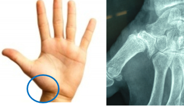 L’arthrose des doigts n’est pas une fatalité Indications et revue des techniques