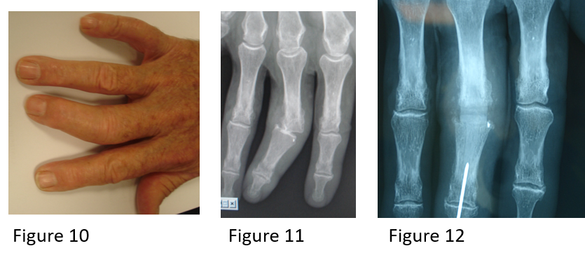 Implants orthopédiques plaque osseuse Truama cubitus Olecranon Plaque de  verrouillage de la plaque cubital - Chine Les instruments chirurgicaux,  cubitus