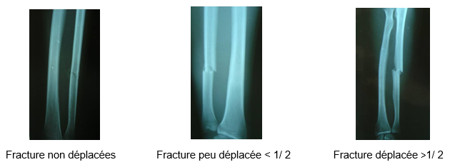 Traitement orthopédique de courte durée des fractures isolées de la diaphyse ulnaire A propos d’une étude prospective de 167 cas