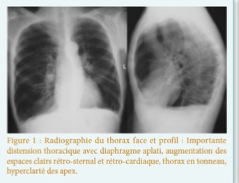 Apport de l’imagerie dans la broncho-pneumopathie chronique obstructive (BPCO)