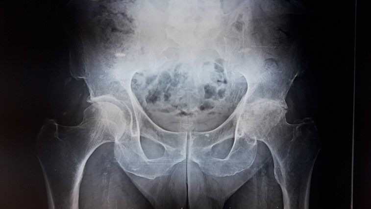 Arthroplastie totale de hanche par voie antérieure.