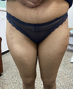 Inégalités de longueur après prothèse totale de hanche bilatérale simultanée.