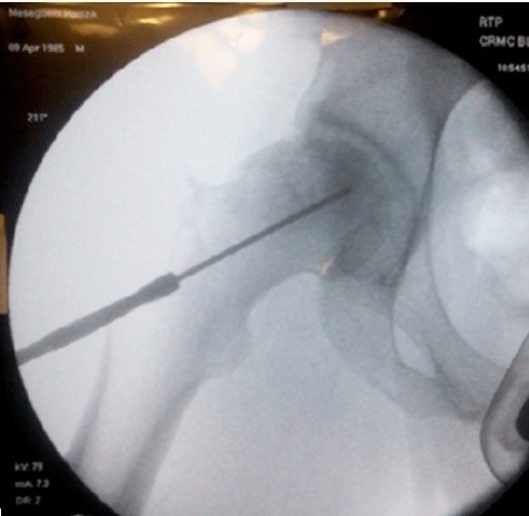 Surgery for osteonecrosis of the femoral head by biopsy drilling: efficacy and limits