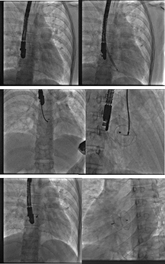 Percutaneous closure technique of the atrial septal defect (ASD) associated with azygous continuity of the inferior vena cava